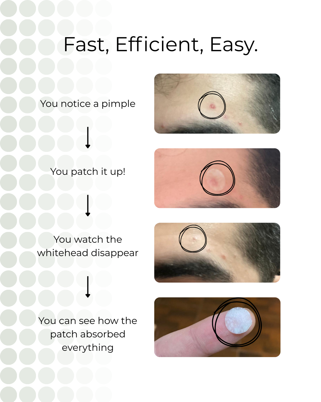 nua's premium pimple patches